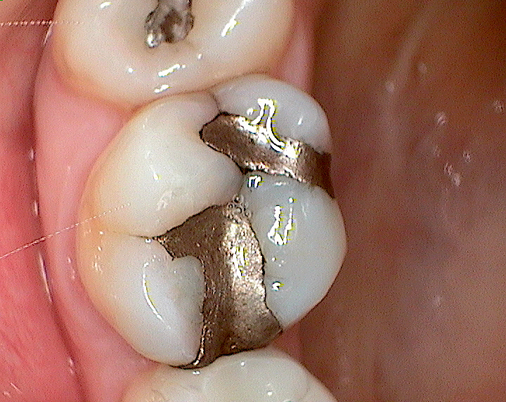 Before with Silver Filling