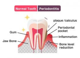 Periodontal disease