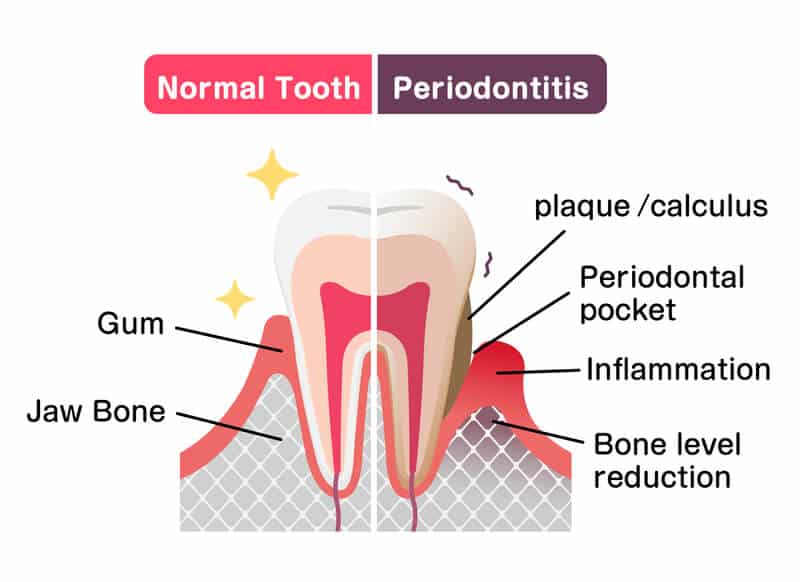 Graph of normal tooth vs periodontitis 