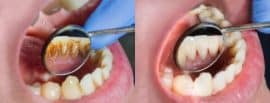 Dentistry treatment of dental plaque