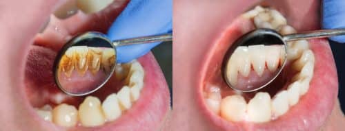 PIcture of Periodontal disease 