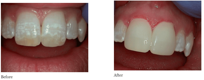 Tooth Reshaping