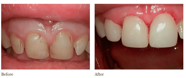 Tooth Veneers