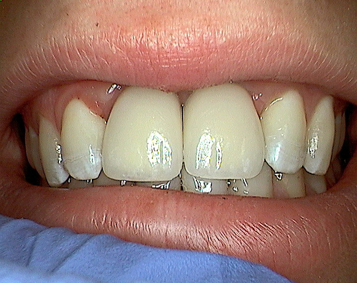 After dental implants