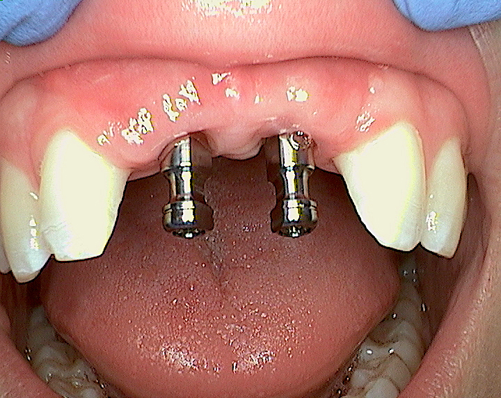 During dental implants